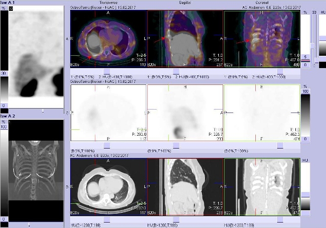 Obr. č. 2: Fúze obrazů SPECT a CT. Vyšetření 4 hod. po aplikaci radioindikátoru. Zaměřeno na drobné ložisko dorzobazálně v pravé plíci.