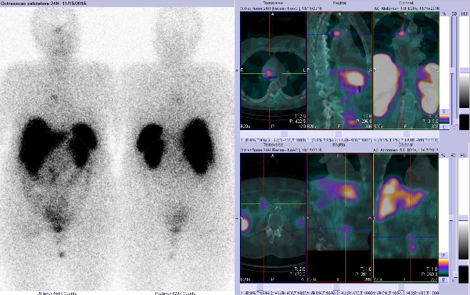 Obr. č. 1: Celotělová scintigrafie v přední a zadní projekci a fúze SPECT/CT 24 hod. po aplikaci OctreoScanu. Zaměřeno na ložisko v hrudníku těsně vpravo od střední čáry.