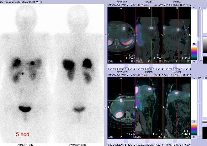 Obr. č. 1: Celotělová scintigrafie v přední a zadní projekci a fúze obrazů SPECT a CT. Vyšetření 5 hod. po aplikaci radioindikátoru. Vpravo nahoře zaměřeno na ložisko v levém jaterním laloku, vpravo dole zaměřeno na ložisko v pravém laloku ventrokraniálně.