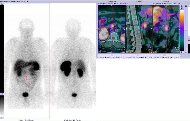 Obr.č.2: Celotělová scintigrafie a fúze obrazů SPECT a CT. Vyšetření 7 hod. po aplikaci radioindikátoru. Zaměřeno na ložisko v pankreatu nebo lymfatické uzlině.