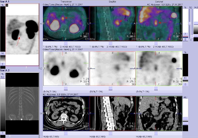 Obr.3: Fúze obrazů SPECT a CT. Vyšetření 7 hod. po aplikaci radioindikátoru. Zaměřeno na ložisko v pankreatu nebo lymfatické uzlině.