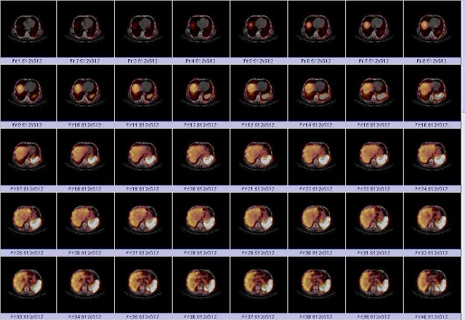 Obr. č. 4: Fúze obrazů SPECT a CT. Vyšetření 24 hod. po aplikaci radioindikátoru.
