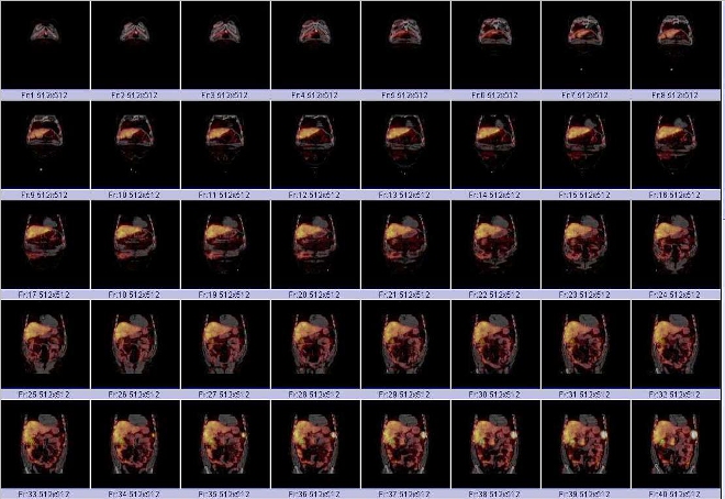 Obr. č. 6: Fúze obrazů SPECT a CT. Vyšetření 24 hod. po aplikaci radioindikátoru.
