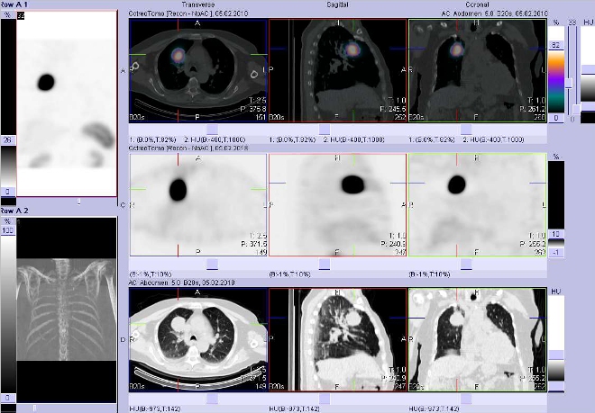 Obr. č. 3: Fúze obrazů SPECT a CT. Vyšetření 4 hod. po aplikaci radioindikátoru. Zaměřeno na ložisko v pravé plíci parahilozně.