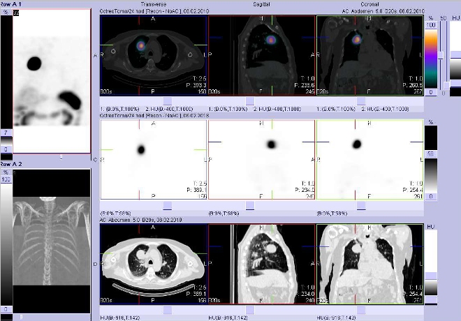 Obr. č. 4: Fúze obrazů SPECT a CT. Vyšetření 24 hod. po aplikaci radioindikátoru. Zaměřeno na ložisko v pravé plíci parahilozně.