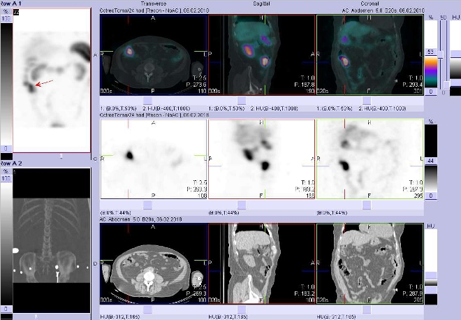 Obr. č. 5: Fúze obrazů SPECT a CT. Vyšetření 24 hod. po aplikaci radioindikátoru. Zaměřeno na střevo.