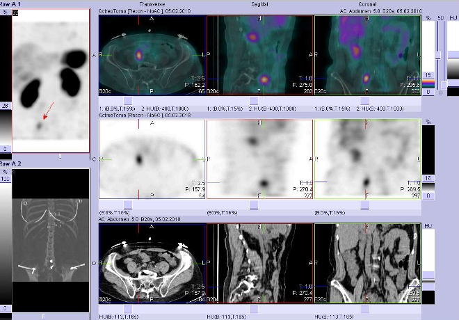 Obr. č. 3: Fúze obrazů SPECT a CT. Vyšetření 5 hod. po aplikaci radioindikátoru. Zaměřeno na střevo.