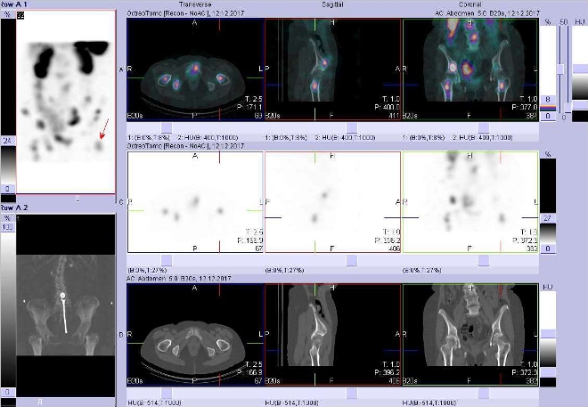 Obr. č. 10: Fúze obrazů SPECT a CT. Zaměřeno na ložisko v proximální části levé stehenní kosti. Vyšetření 24 hod. po aplikaci OctreoScanu.