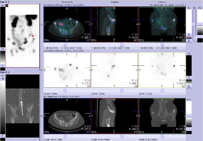 Obr. č. 12: Fúze obrazů SPECT a CT. Zaměřeno na ložisko v lopatě levé kosti kyčelní. Vyšetření 24 hod. po aplikaci OctreoScanu.