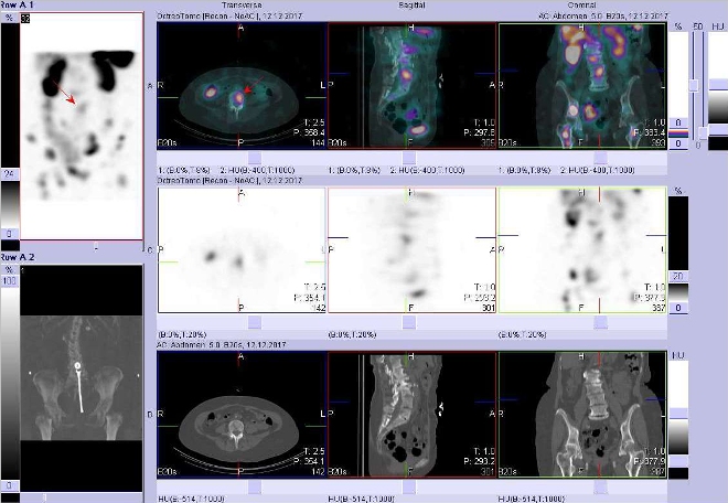 Obr.14: Fúze obrazů SPECT a CT. Zaměřeno na ložisko v bederním obratli. Vyšetření 24 hod. po aplikaci OctreoScanu.