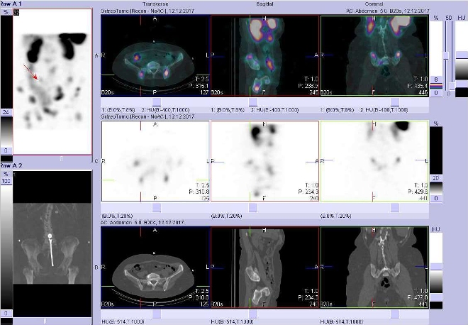 Obr. č. 15: Fúze obrazů SPECT a CT. Zaměřeno na ložisko v lopatě pravé kosti kyčelní. Vyšetření 24 hod. po aplikaci OctreoScanu.