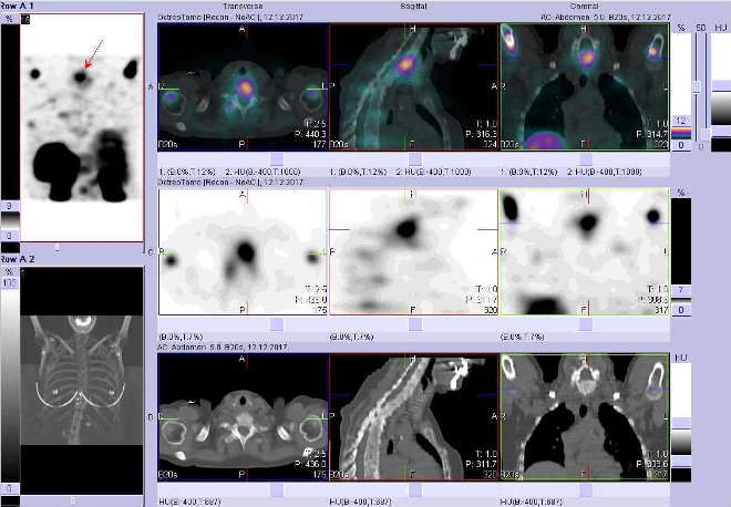 Obr. č. 17: Fúze obrazů SPECT a CT. Zaměřeno na ložisko v krčním obratli. Vyšetření 24 hod. po aplikaci OctreoScanu.