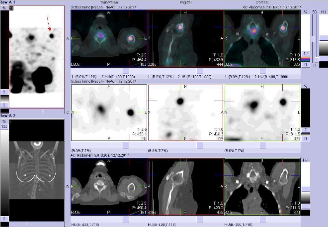 Obr. č. 18: Fúze obrazů SPECT a CT. Zaměřeno na ložisko v proximální části levé pažní kosti. Vyšetření 24 hod. po aplikaci OctreoScanu.