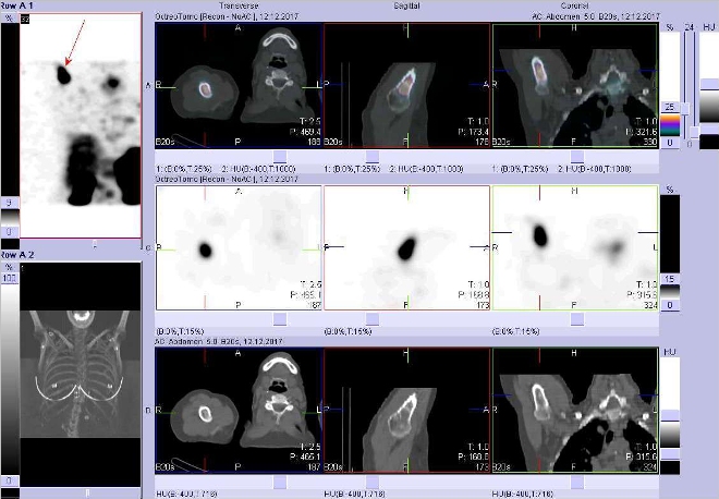 Obr. č. 19: Fúze obrazů SPECT a CT. Zaměřeno na ložisko v proximální části pravé pažní kosti. Vyšetření 24 hod. po aplikaci OctreoScanu.