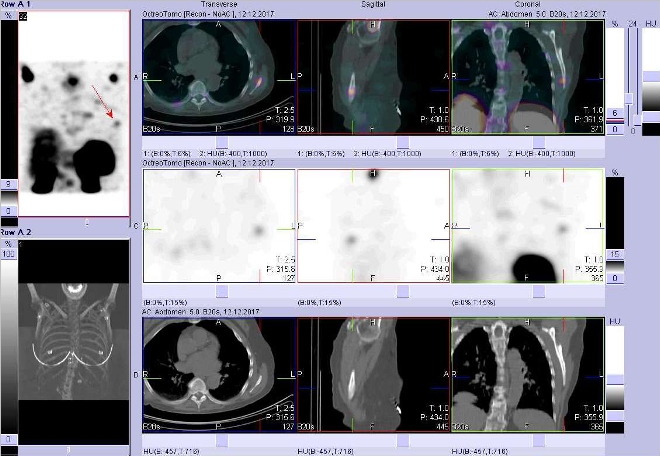 Obr. č. 20: Fúze obrazů SPECT a CT. Zaměřeno na ložisko v levé lopatce. Vyšetření 24 hod. po aplikaci OctreoScanu.