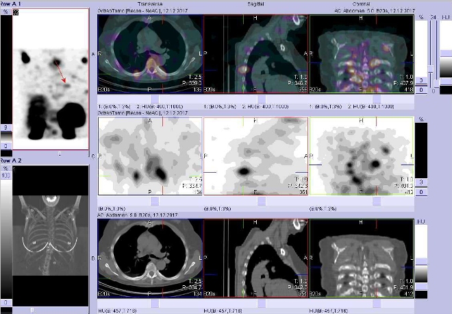 Obr. č. 21: Fúze obrazů SPECT a CT. Zaměřeno na ložisko kostovertebrálně vlevo. Vyšetření 24 hod. po aplikaci OctreoScanu.