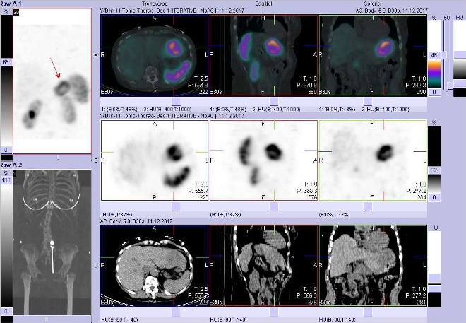 Obr.3: Fúze obrazů SPECT a CT. Zaměřeno na ložisko v levém jaterním laloku. Vyšetření 5 hod. po aplikaci OctreoScanu.