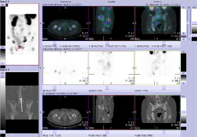 Obr. č. 8: Fúze obrazů SPECT a CT. Zaměřeno na ložisko v pravé sedací kosti. Vyšetření 24 hod. po aplikaci OctreoScanu.