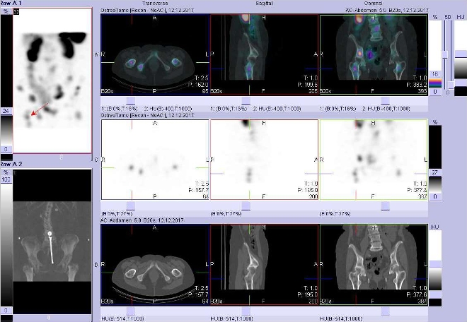 Obr. č. 9: Fúze obrazů SPECT a CT. Zaměřeno na ložisko v proximální části pravé stehenní kosti. Vyšetření 24 hod. po aplikaci OctreoScanu.