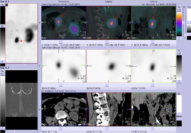 Obr. č. 3: Fúze obrazů SPECT a CT. Zaměřeno na ložisko paraaortálně vpravo v uzlině v úrovni L2/L3. Vyšetření 4 hod. po aplikaci radioindikátoru.