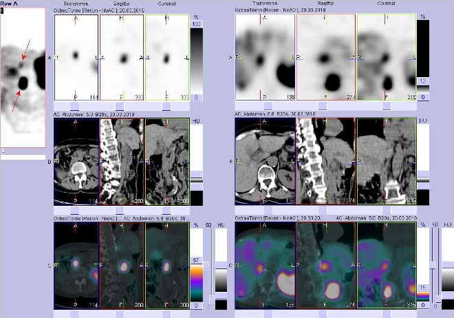 Obr. č. 5: Fúze obrazů SPECT a CT. Zaměřeno na ložisko paravertebrálně vpravo a paraaortálně vpravo. Vyšetření 24 hod. po aplikaci radioindikátoru.