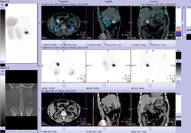 Obr. č. 4: Fúze obrazů SPECT a CT. Vyšetření 4 hod. po aplikaci radioindikátoru. Zaměřeno na ložisko mezi pankreatem a duodenem.