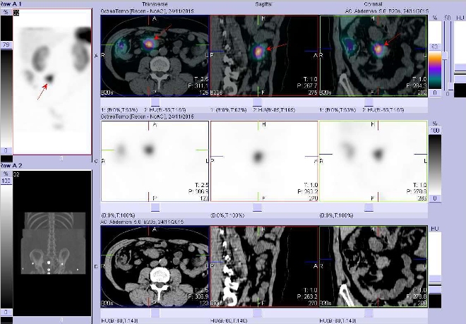 Obr. č. 2: SPECT, CT a fúze obrazů SPECT a CT. Vyšetření 24 hod. po aplikaci radioindikátoru. Nahoře fúze obrazů, uprostřed obrazy SPECT, dole obrazy CT, vždy vlevo transverzální  řezy, uprostřed sagitální řezy, vpravo řezy koronární. Zaměřeno na ložisko v břiše v pravém mesogastriu.