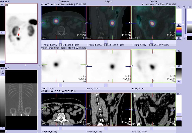 Obr. č. 5: SPECT, CT a fúze obrazů SPECT a CT. Vyšetření 24 hod. po aplikaci radioindikátoru. Nahoře fúze obrazů, uprostřed obrazy SPECT, dole obrazy CT, vždy vlevo transverzální  řezy, uprostřed sagitální řezy, vpravo řezy koronární. Zaměřeno na ložisko v břiše v pravém mesogastriu.