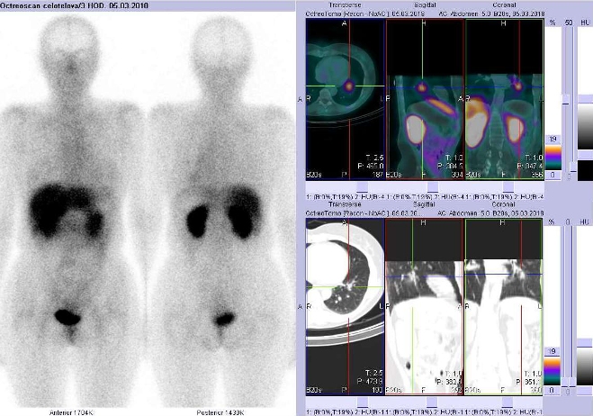 Obr. č. 2: Celotělová scintigrafie a fúze SPECT/CT 3,5 hod. po aplikaci OctreoScanu. Zaměřeno na ložisko v levé plíci.