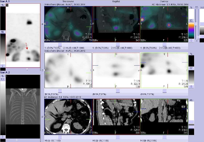 Obr. č. 5: Fúze SPECT/CT 4 hod. po aplikaci OctreoScanu. Zaměřeno na ložisko v lymfatické uzlině paraaortálně vlevo v úrovni Th12.