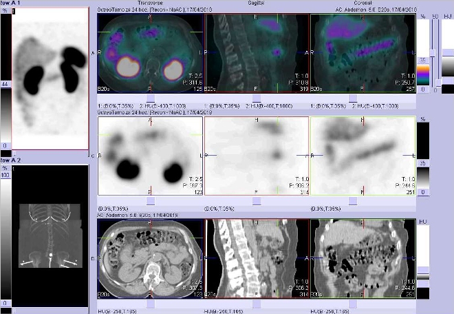 Obr. č. 11: Fúze SPECT/CT břicha 24 hod. po aplikaci OctreoScanu.