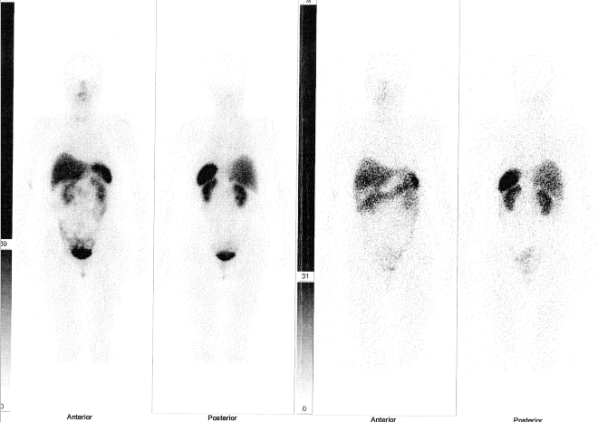 Obr. č. 2: Celotělová scintigrafie v přední a zadní projekci 4 (vlevo) a 24 (vpravo) hod. po aplikaci OctreoScanu.