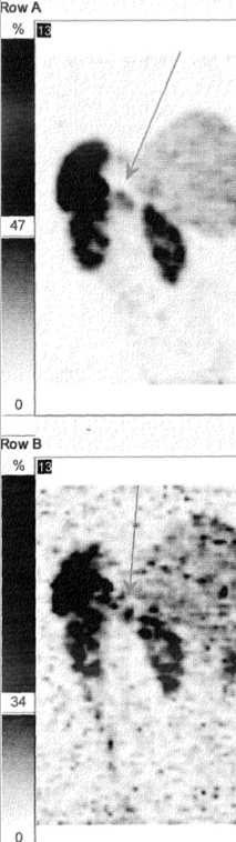 Obr. č. 5: SPECT břicha 24 hod. po aplikaci OctreoScanu. Zaměřeno na ložisko vlevo od střední čáry v blízkosti sleziny (horního pólu levé ledviny).
