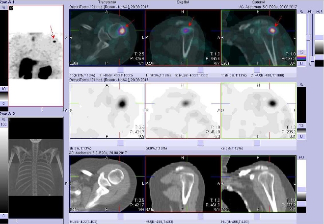 Obr. č. 3: Fúze obrazů SPECT a CT. Vyšetření 24 hod. po aplikaci radioindikátoru. Zaměřeno na ložisko v laterální části hlavice levé pažní kosti.