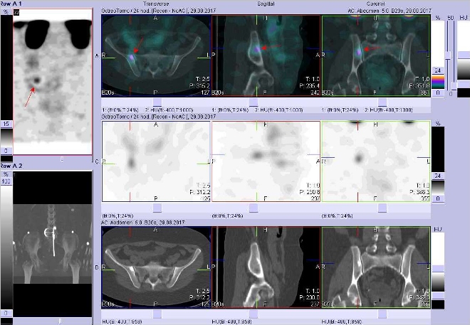 Obr. č. 4: Fúze obrazů SPECT a CT. Vyšetření 24 hod. po aplikaci radioindikátoru. Zaměřeno na ložisko v kosti kyčelní vpravo těsně u SI skloubení.