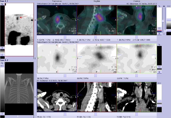 Obr. č. 5: Fúze obrazů SPECT a CT. Vyšetření 24 hod. po aplikaci radioindikátoru. Zaměřeno na pravý lalok štítné žlázy.