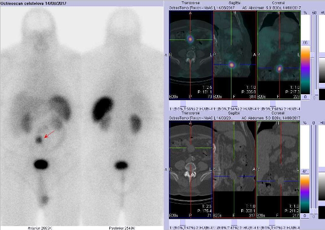 Obr. č. 2: Celotělová scintigrafie a fúze SPECT/CT břicha 4 hod. po aplikaci OctreoScanu. Zaměřeno na ložisko v mezenteriu v blízkosti pupku.