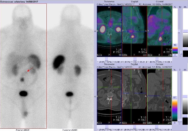 Obr. č. 3: Celotělová scintigrafie a fúze SPECT/CT břicha 4 hod. po aplikaci OctreoScanu. Zaměřeno na málo aktivní ložisko v duodenu.