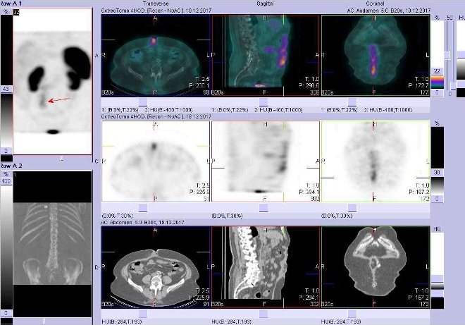 Obr. č. 5: Fúze SPECT/CT břicha a pánve 4 hod. po aplikaci OctreoScanu. Zaměřeno na ložisko v průběhu jizvy po laparotomii vpravo od střední čáry.