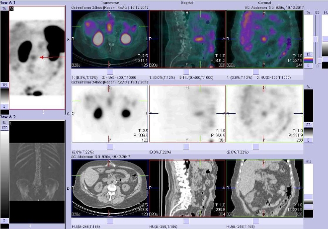 Obr. č. 7: Fúze SPECT/CT břicha a pánve 24 hod. po aplikaci OctreoScanu. Zaměřeno na ložisko v infiltrátu při uncinátním výběžku pankreatu.