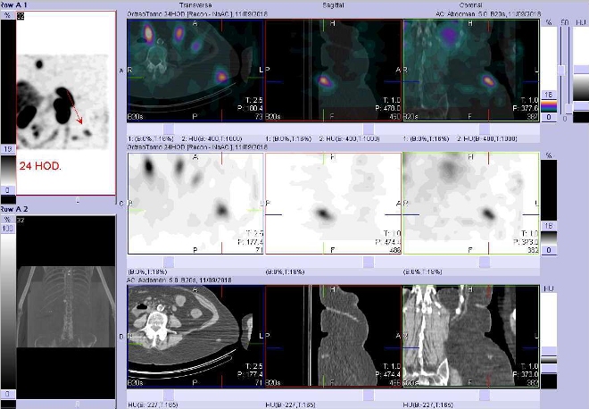 Obr. č. 10: Fúze SPECT/CT 24 hod. po aplikaci OctreoScanu. Zaměřeno na jedno ze dvou podkožních ložisek v úrovni přechodu břicha a pánve vlevo.