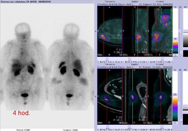Obr. č. 4: Celotělová scintigrafie v přední a zadní projekci a fúze SPECT/CT 4 hod. po aplikaci OctreoScanu. Zaměřeno na podkožní ložisko v úrovni přechodu břicha a pánve vpravo.