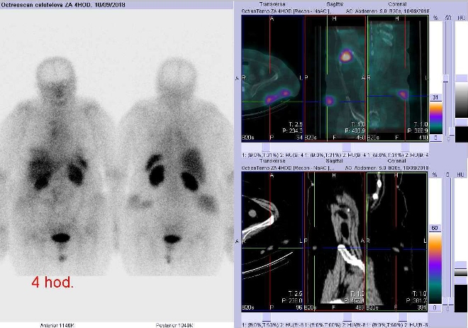 Obr. č. 5: Celotělová scintigrafie v přední a zadní projekci a fúze SPECT/CT 4 hod. po aplikaci OctreoScanu. Zaměřeno na podkožní ložiska v úrovni přechodu břicha a pánve vlevo.