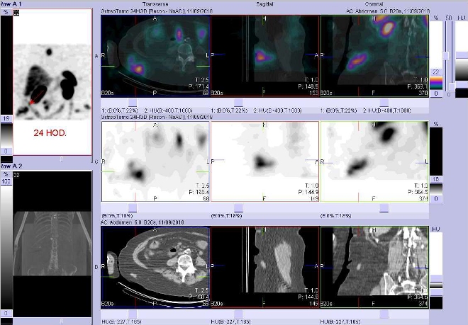 Obr. č. 9: Fúze SPECT/CT 24 hod. po aplikaci OctreoScanu. Zaměřeno na podkožní ložisko v úrovni přechodu břicha a pánve vpravo.