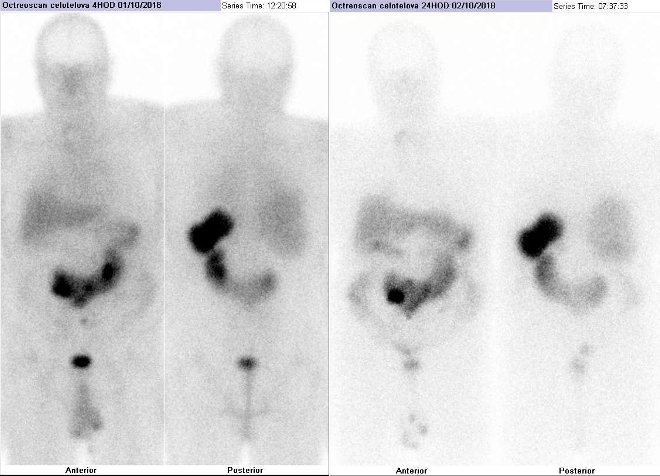 Obr. č. 1: Celotělová scintigrafie v přední a zadní projekci za 4 (vlevo) a 24 hod. (vpravo) po aplikaci radiofarmaka.