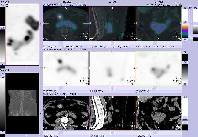 Obr. č. 3: Fúze obrazů SPECT a CT. Vyšetření 4 hod. po aplikaci radioindikátoru. Zaměřeno na podkovovitou ledvinu.