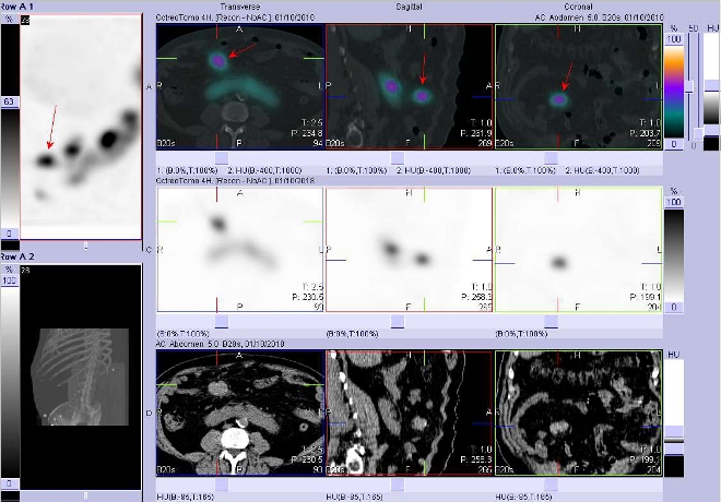 Obr. č. 4: Fúze obrazů SPECT a CT. Vyšetření 4 hod. po aplikaci radioindikátoru. Zaměřeno na ložisko v pravém mezogastriu.