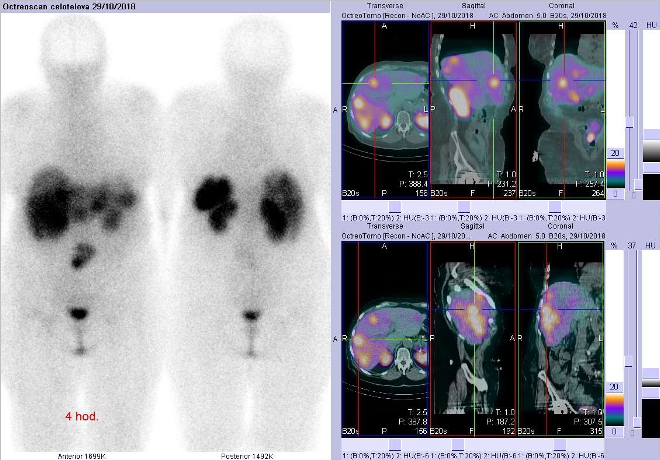 Obr. č. 1: Celotělová scintigrafie v přední a zadní projekci a fúze obrazů SPECT a CT. Zaměřeno na ložiska v pravém jaterním laloku. Vyšetření 4 hod. po aplikaci OctreoScanu.