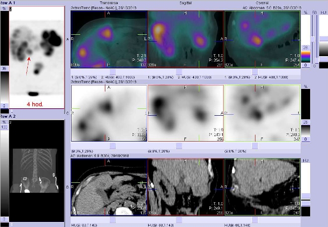Obr. č. 2: Fúze obrazů SPECT a CT. Zaměřeno na jaterní ložisko. Vyšetření 4 hod. po aplikaci OctreoScanu.