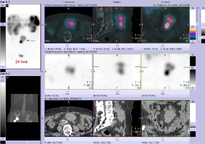 Obr. č. 4: Fúze obrazů SPECT a CT. Zaměřeno na ložisko ve středním mezogastriu ventrálně. Vyšetření 24 hod. po aplikaci OctreoScanu.
